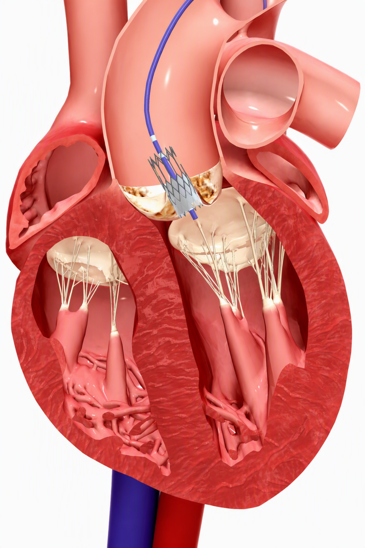 Neurovascular coils